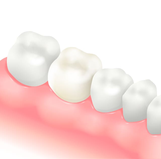 crown_ceramic