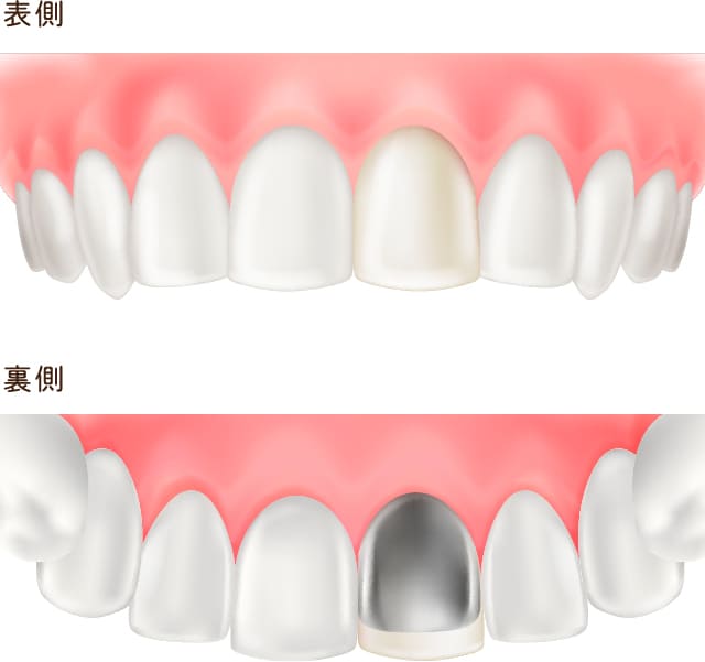 crown_resin_facing_uraomote