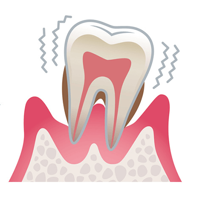 periodontal_03